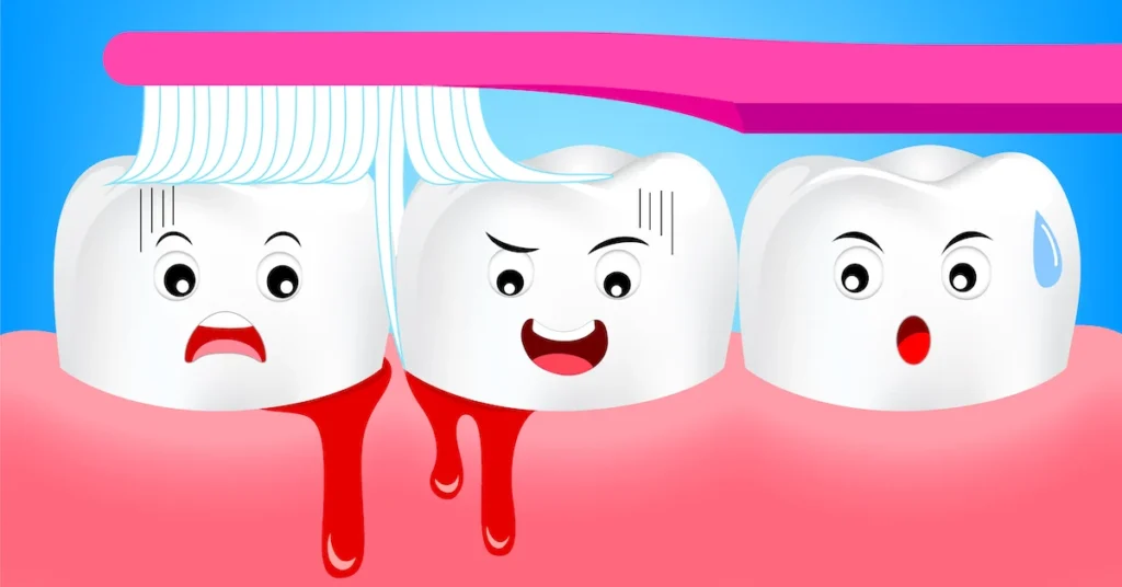 Is Bleeding Gums an Early Sign of Gum Disease Wolverhampton?
